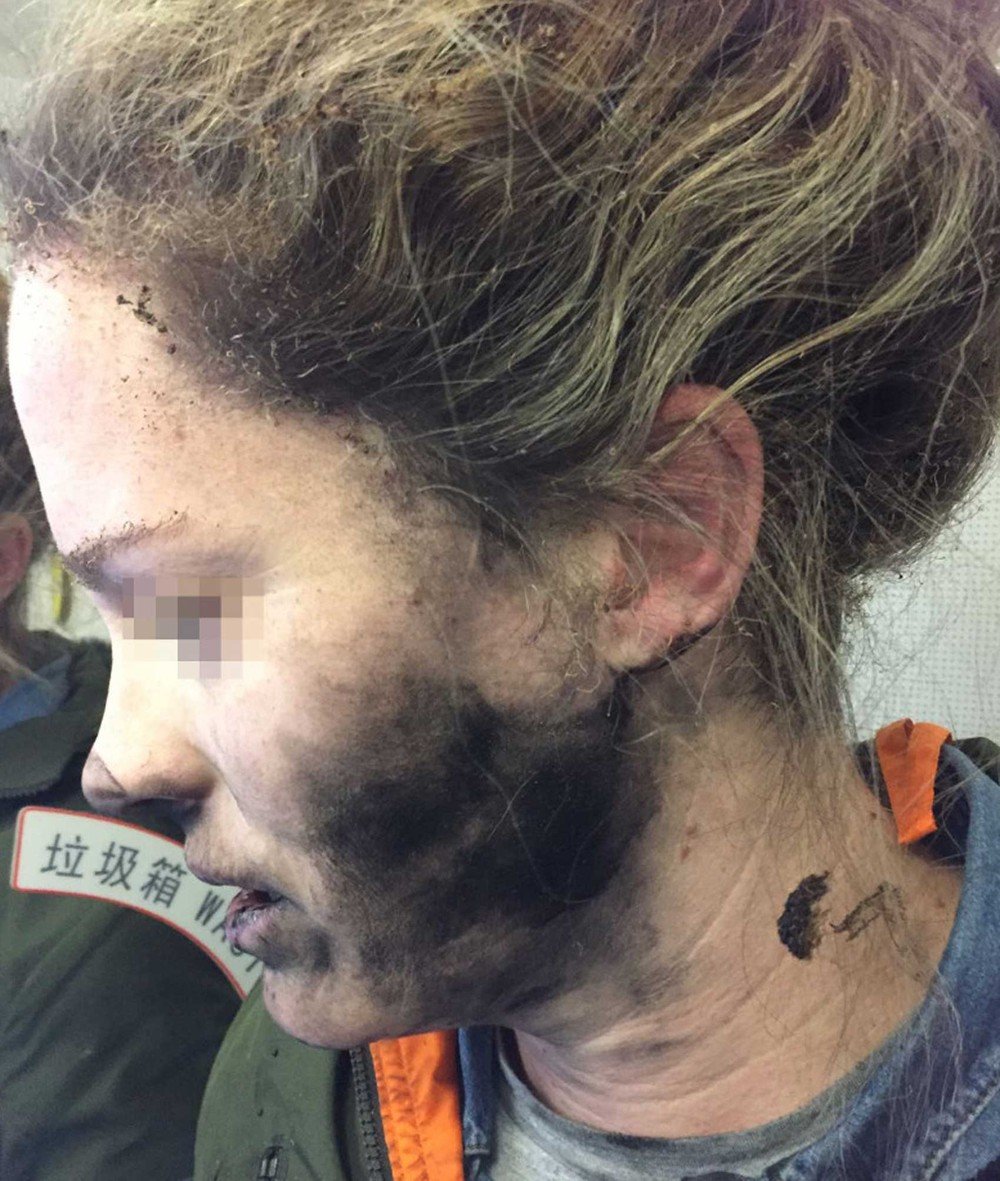 Passageira teve o cabelo chamuscado e ficou com o rosto sujo de fuligem (Foto: ATSB/ Divulgação)